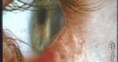 Keratoconus