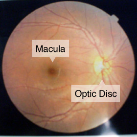 Macular Hole