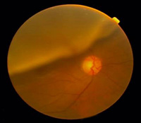 Retinal Detachment