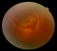 Retinal tear