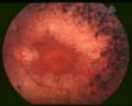 Retinitis Pigmentosa