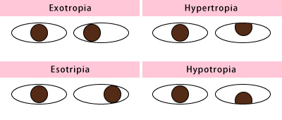 uveitis