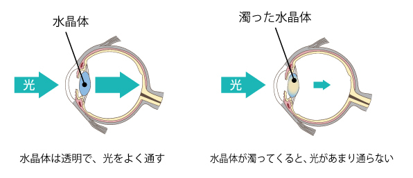 片目 で 見る と 暗く なる