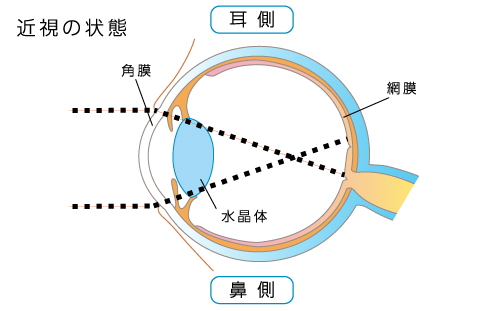 近視の状態