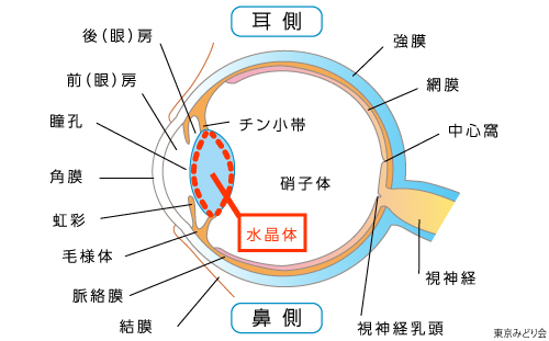 白内障