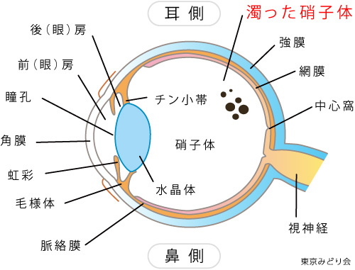 飛蚊症の原因