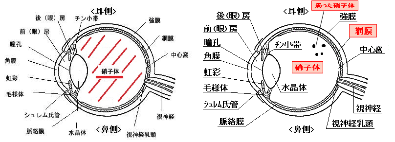 飛蚊症の原因