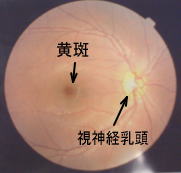 加齢性黄斑変性症