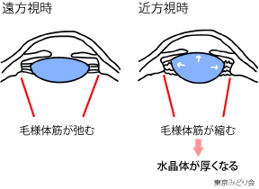 仮性近視