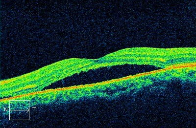 中心性網膜症OCT