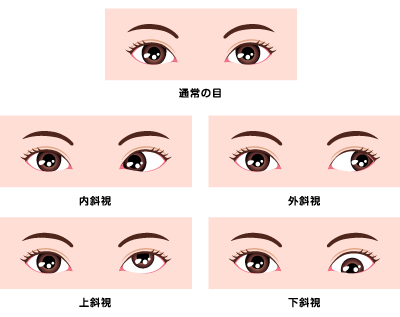 斜視とは