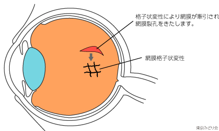 網膜格子状変性とは