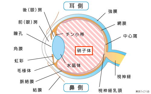 硝子体混濁