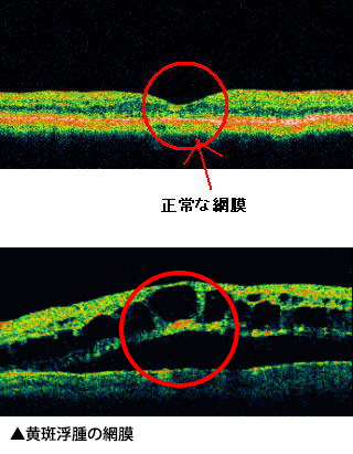 正常な網膜/黄斑浮腫の網膜