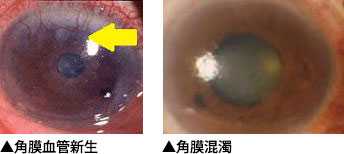 角膜輪部フリクテン
