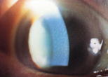 角膜ジストロフィー