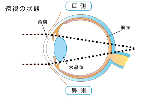 遠視の状態