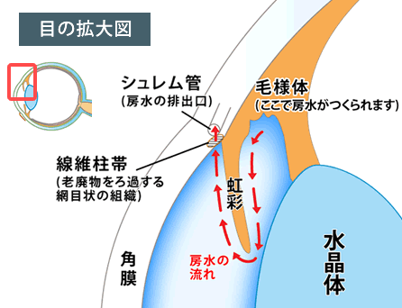 原発性閉塞隅角縁緑内障