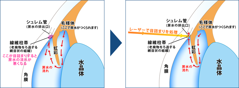 レーザー治療図解