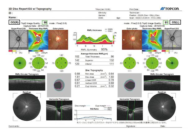 視神経乳頭形状解析レポート