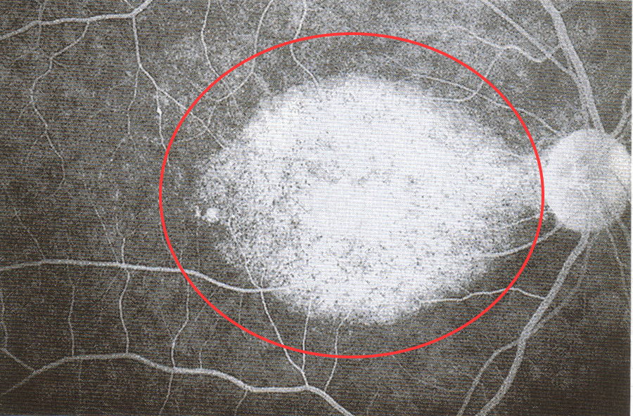 蛍光眼底検査の撮影画像