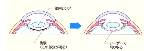 白内障后发障 切开手术