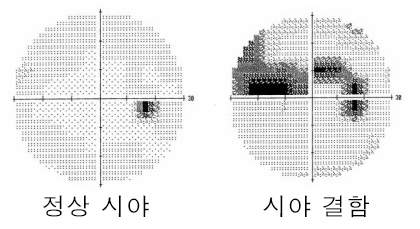 A curtain-like shadow over your visual field