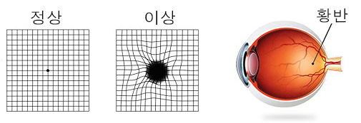 Macular Degeneration