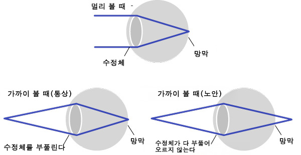 presbyopia